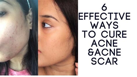 How To Cure Acne And Acne Scar Faster 6 Effective Natural Ways I Home