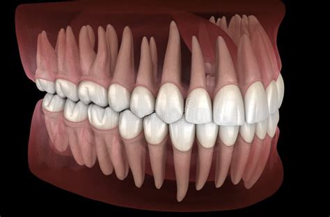 Morphology Of Mandibular And Maxillary Human Gum And Teeth Medically