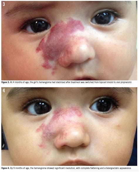 Infantile Hemangioma Management Of A Girls Growing Facial Lesion Consultant360