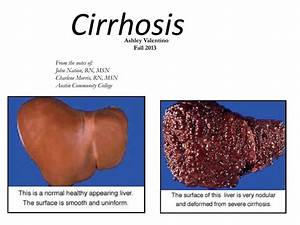 Cirrhosis ppt - print and bring to class Cirrhosis  