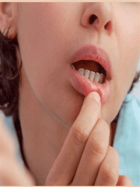 Mouth Ulcer In Hindi Vediclifestyle Hot Sex Picture