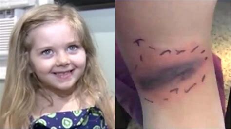 5 Year Olds Purple Bruise Turns Out To Be Potentially Deadly Spider