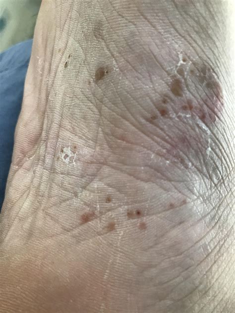 Is This Dyshidrosis Eczema Or Vesicular Tinea Pedis Sole Of Foot Have
