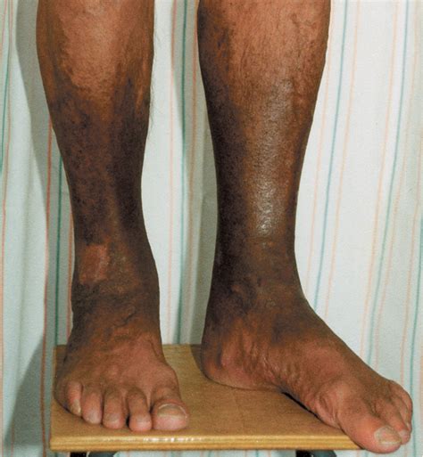 Brown Skin Discoloration On Lower Legs Dark Spots On