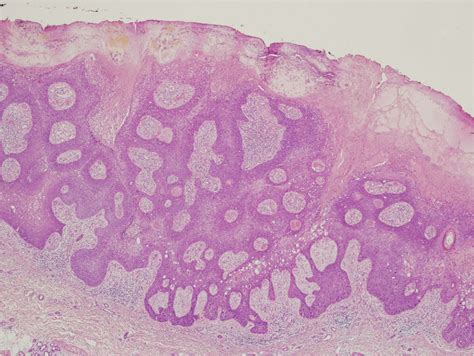 Eccrine Porocarcinoma Composed Of Basaloid Cells With Focal