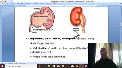 Urology 15 Stricture Ureter By Dr Wahdan Youtube