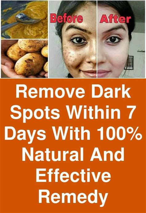 Remove Dark Spots Within 7 Days With 100 Natural And Effective Remedy