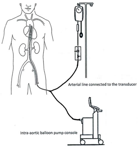 Intra Aortic Balloon Pump Catheter