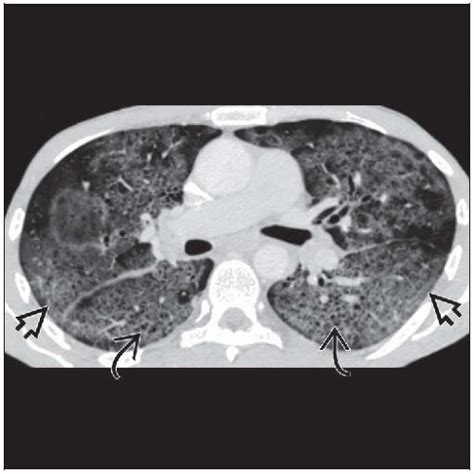 Pneumocystis Jiroveci Pneumonia Radiology Key