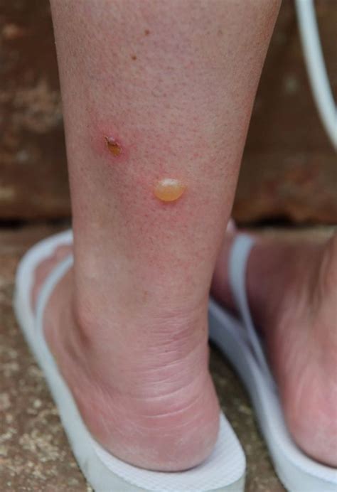Mosquito Bite On Foot Wholesale Discounts Save 67 Jlcatjgobmx