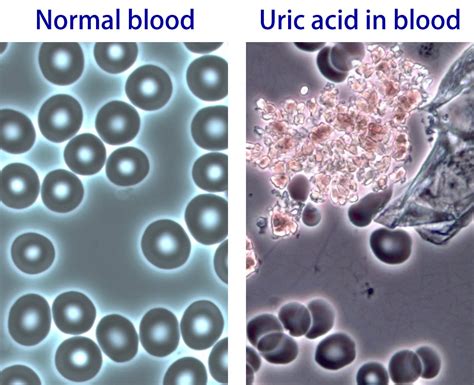 Plasma uric acid (pua) is associated with metabolic, cardiovascular, and renal abnormalities in patients with type 2 diabetes but is less well our aim was to compare pua levels and fractional uric acid excretion (feua) in patients with t1d vs. Uric acid - blood . Causes, symptoms, treatment Uric acid ...
