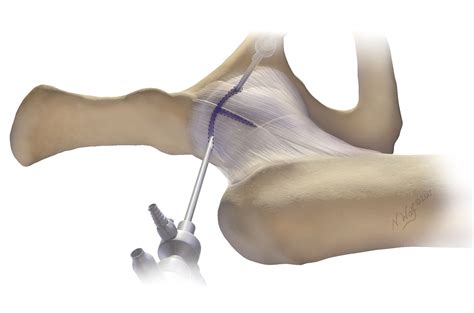 Use Of Puncture Capsulotomy During Hip Arthroscopy Mass General