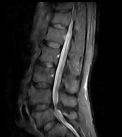 Lumbar Canal Stenosis Radiology Reference Article Radiopaedia Org