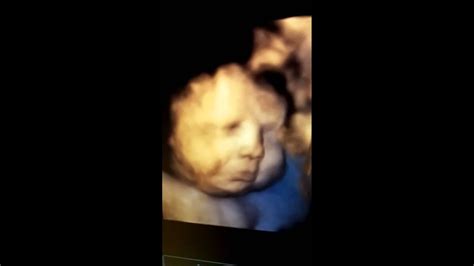 How can a premature birth harm your baby? Baby boy crying in the womb - YouTube