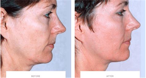 Laser Skin Tightening Before And After Thermage Morpheus8 Ultherapy