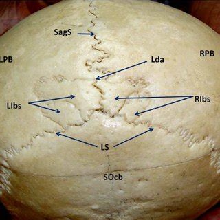 Check spelling or type a new query. Showing four interparietal bones. SagS- Sagital suture ...