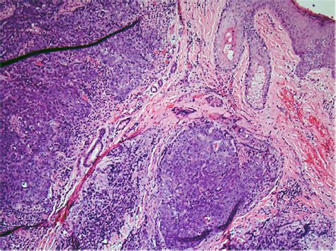 Cutaneous Metastasis A Rare Herald Of A Silent Cancer Bmj Case Reports