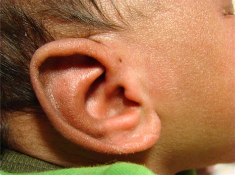 Pediatric Pearls Infants Ear Pits Tags And The Pinna