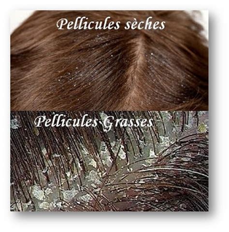 Pellicules Et Desquamations Clinique Du Cheveu