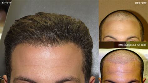 FUE Hair Transplantation Before And After Pictures Dr Turowski