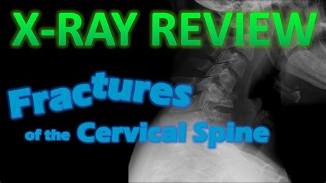 Fractures Of The Cervical Spine Fracture Trauma Cervical Youtube