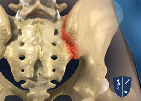 Check spelling or type a new query. Sacroiliac Joint Steroid Injection | Alabama Pain Physicians