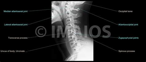 Spine Cervical Vertebrae C I C VII Radiography Atlas C I Axis C II Dens Of Axis