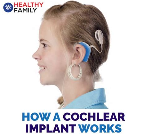 How A Cochlear Implant Works Health Magazine