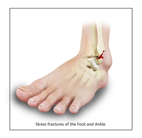 Stress Fracture Of The Foot Springfield Foot Fracture East Longmeadow