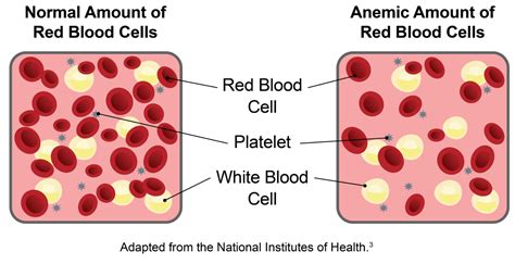 What Is Anemia Ferralet® 90