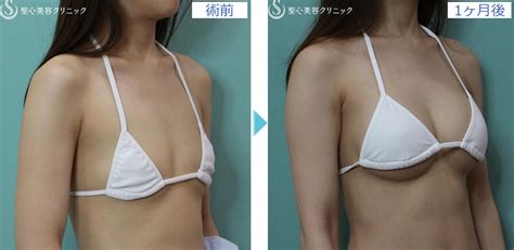 胸をしっかり大きく 豊胸術の症例写真 福岡の美容整形外科皮膚科なら聖心美容クリニック福岡院