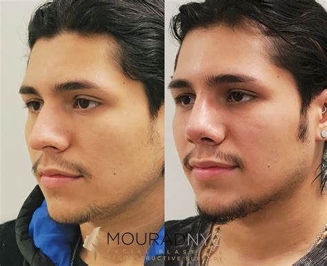 Male Rhinoplasty Before And After Facial Plastic Surgeon