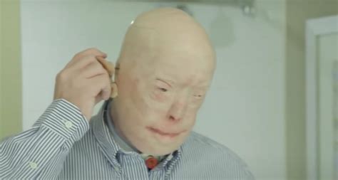 After Third Degree Burns A Firefighter Receives A Face Transplant And