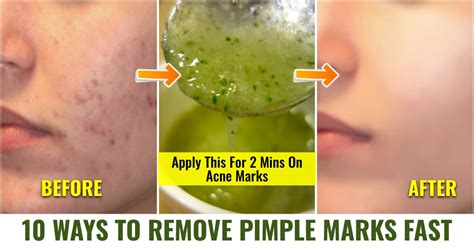 How To Remove Pimple Marks In One Day