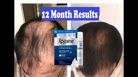 Does Rogaine REALLY Work Month RESULTS MENS ROGAINE Minoxidil Hair Regrowth