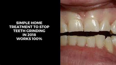 Teeth grinding, also known as bruxism, isn't just an annoyance. 5 ultimate home treatment to stop jaw clenching| grinding ...