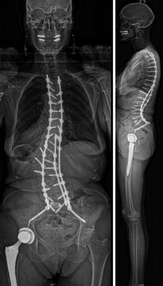 Patient Reported Outcomes Following The Treatment Of Adult Lumbar