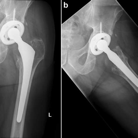 Anteroposterior A And Lateral B Radiographs Of The Left Hip Before