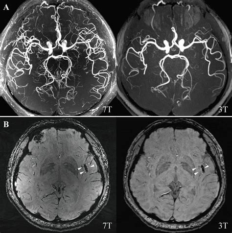 M2 Middle Cerebral Artery Dissection On 7T MRI Stroke And Vascular