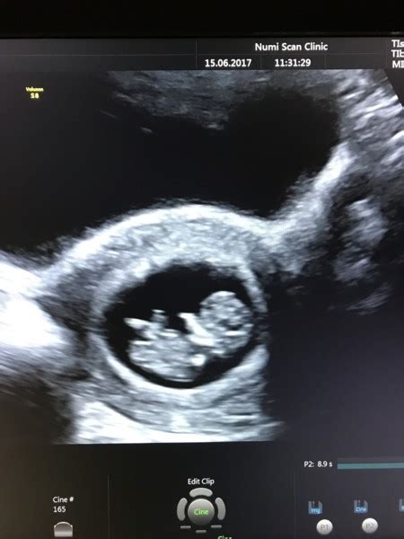 It's the best way to predict your as long as the timings are right, you can have the nt ultrasound and blood test at the same appointment as your dating scan (audibert et al 2017). Prices/Packages | Numi scan