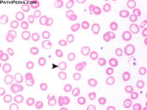 92 Best images about patho on Pinterest | Blood cells, Red ...