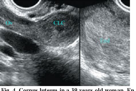 Figure 4 From Tubal Ring Sign Of Ectopic Pregnancy Versus Corpus Luteum