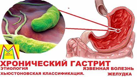 Язва 12 симптомы и диета ХРОНИЧЕСКИЙ ГАСТРИТ и ЯЗВА ЖЕЛУДКА. Этиология. Классификация - YouTube ХРОНИЧЕСКИЙ ГАСТРИТ и ЯЗВА ЖЕЛУДКА. Этиология. Классификация - YouTube Язва 12 симптомы и диета