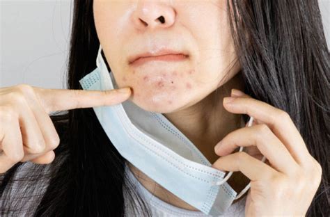 Our team is dedicated to finding and telling you more about the products and deals we love. 'Maskne' is the new acne: here's how treat and prevent it