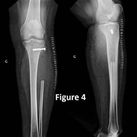 Frontal And Lateral Control Radiograph Showing The Fibular Head Fixed