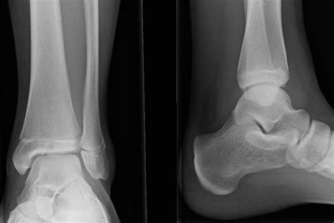 Ankle X Ray Anatomy