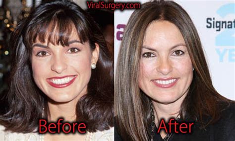 Mariska Hargitay Plastic Surgery Before After Botox And Boob Job Pictures