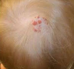 These bumps appear because of ingrown hairs that go up to the scalp, but get trapped beneath the top, visible layer of the skin. Itchy Bumps on Scalp, Neck, Causes, Red, Hurts, Pictures ...