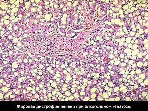 Паренхиматозные дистрофии - презентация онлайн Картинка - Паренхиматозные дистрофии - презентация онлайн