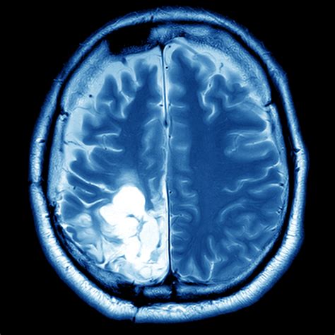 Learn important information about brain tumors including the average age for brain tumor diagnosis & how many tumors are diagnosed per year in america. Brain Tumors Experts New Jersey | CNSOmd NJ